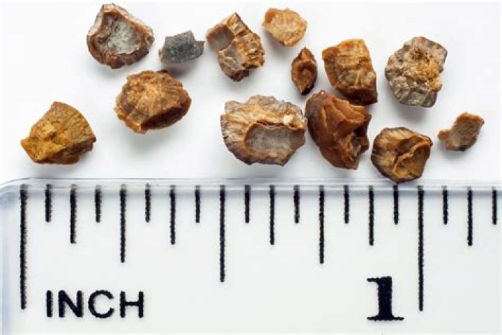 Can you pass a 6.5 mm kidney stone