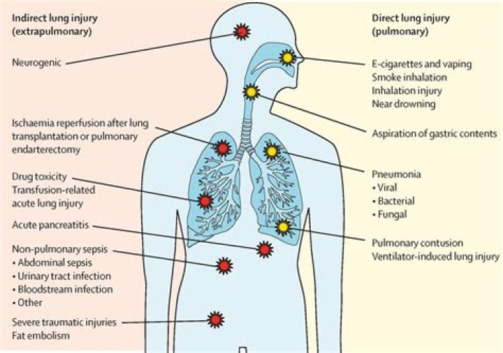 How do you manage respiratory failure